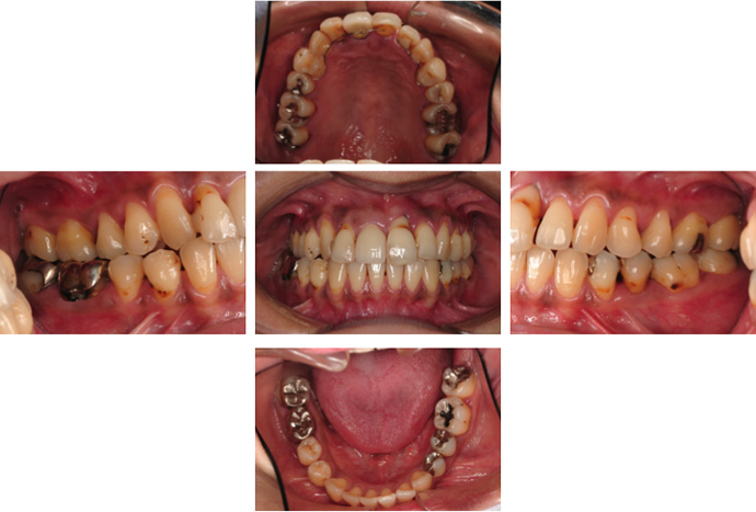 重度歯周病の治療例1 30代女性 豊島区の歯周病専門医