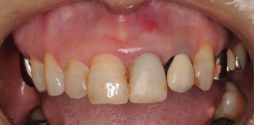 前歯 の 隙間 虫歯